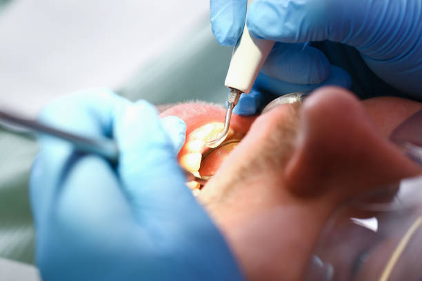 Best Emergency Tooth Extraction in Pine, AZ